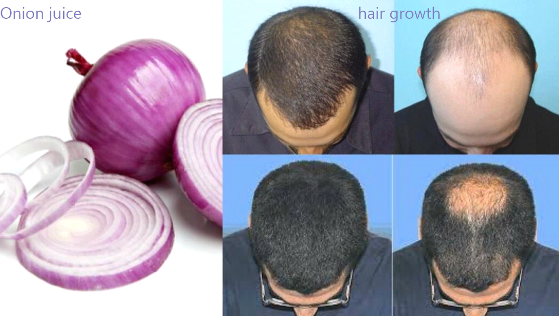 The Benefits of Onion Juice for Hair Growth: Does It Actually Work?