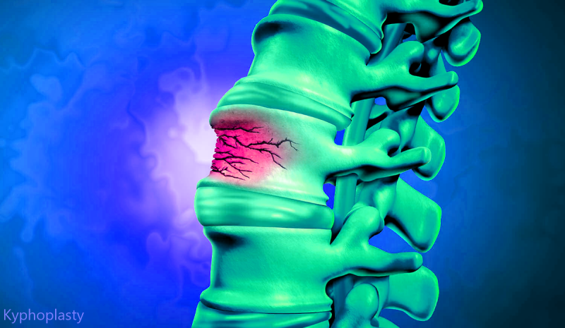 Kyphoplasty: An Option For Spinal Compression Fractures That Is Less ...